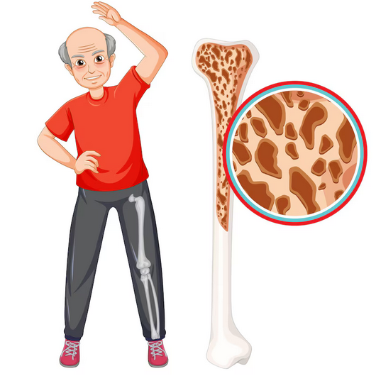 هشاشة العظام (Osteoporosis)